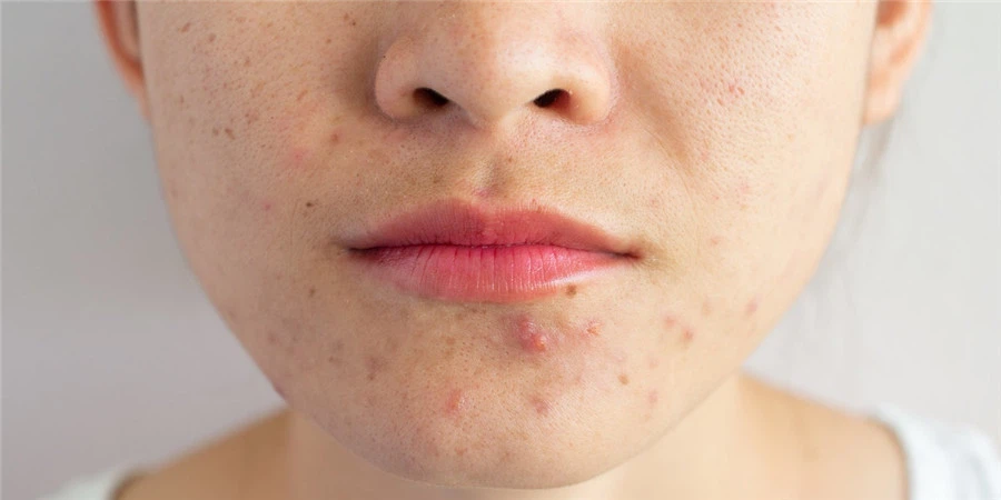 DHEA side effect DHEA side effect