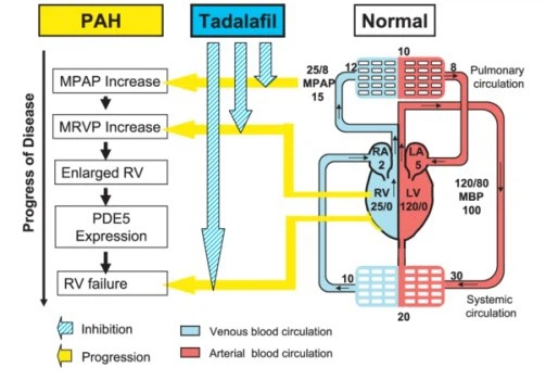 Pulmonary Arterial Hypertension PAH Pulmonary Arterial Hypertension PAH